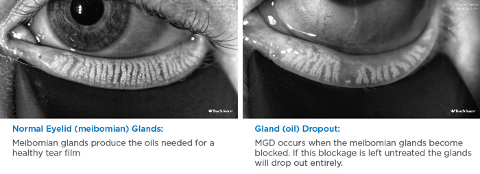 Showing a Normal Eyelid vs Gland Dropout
