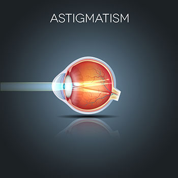 Astigmatism: Symptoms, Tests & Treatment