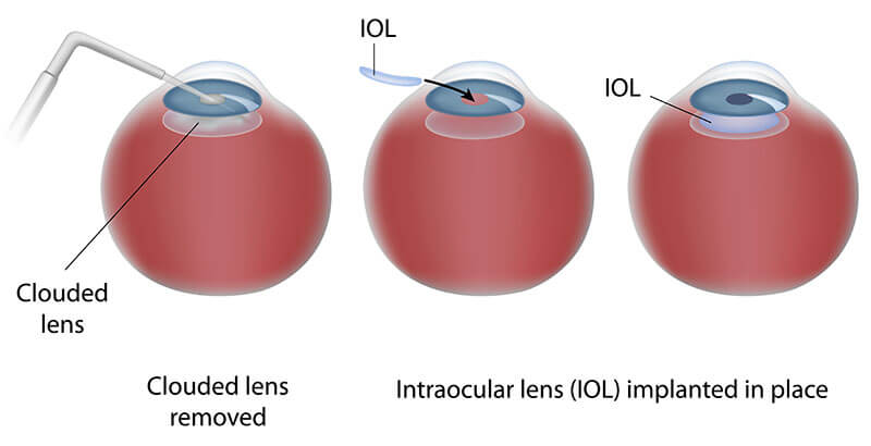 Chart Showing the Cataract Surgery Process