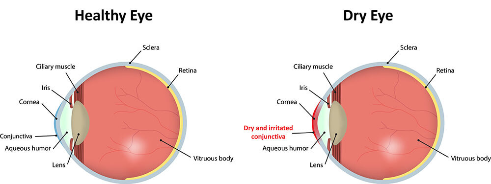 Chart Showing a Healthy Eye Compared to One Suffering From Dry Eye