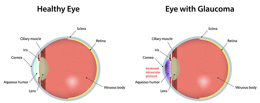 Healthy Eye Compared to One With Glaucoma