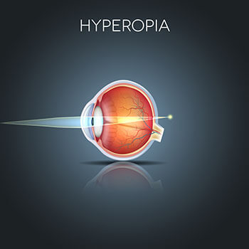 Chart Showing How Hyperopia Affects the Eye