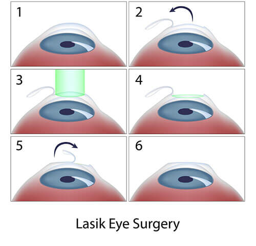 Chart Showing the LASIK Process