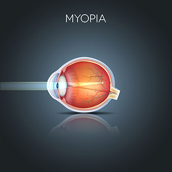 Chart Showing How Myopia Affects the Eye