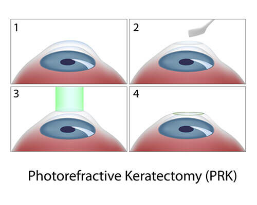 Chart Showing the PRK Process